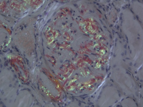 amyloid aflejringer i glomerulos